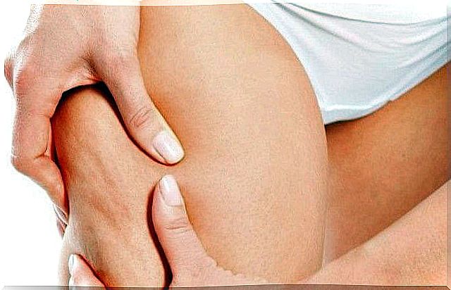 recover after childbirth: woman shows cellulite on thighs
