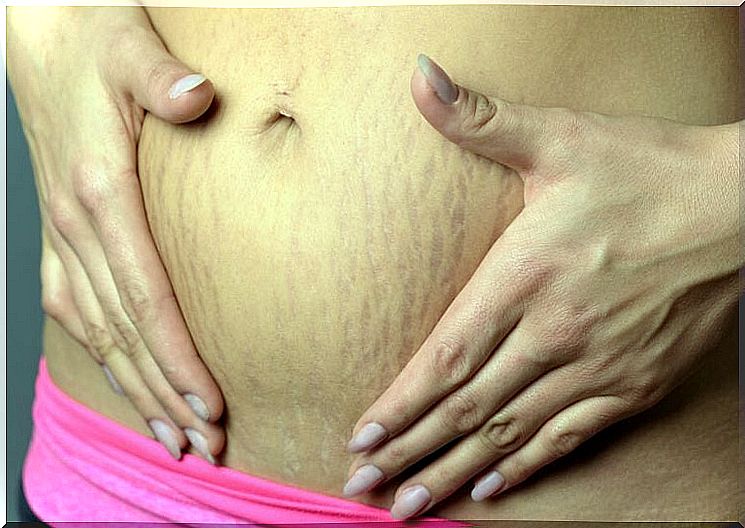 How to get rid of stretch marks during pregnancy
