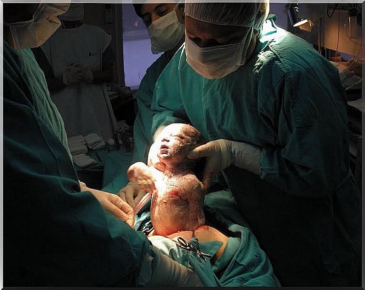 childbirth where the baby is taken out of the mother's body by a person in surgery