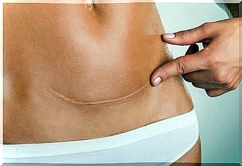 abdomen with scars of a cesarean section after childbirth
