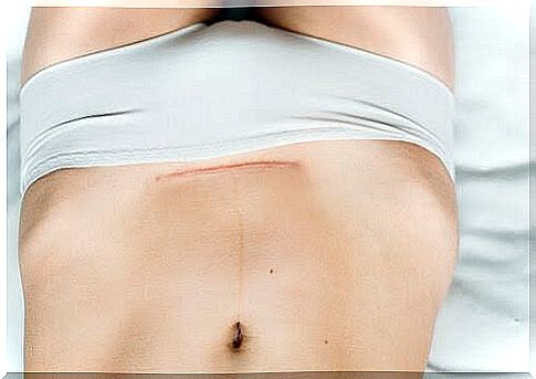 Stomach with scars of a cesarean section after childbirth